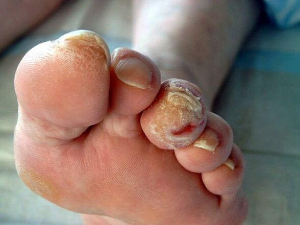 Diabetic foot and onycoicosis