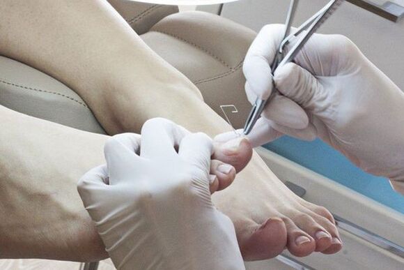 Mechanical removal of nails affected by mushrooms