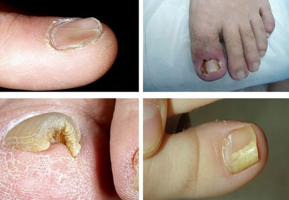Signs of onyokomycosis in the legs